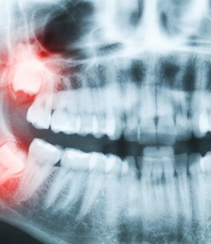 Oral Surgery | Woodlands Dental | General and Family Dentist | SW Calgary AB